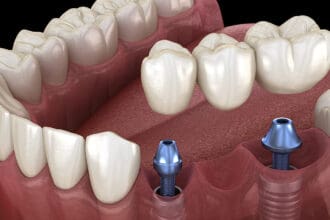 30 Best Dental Implants In India