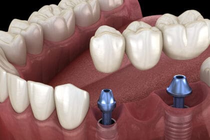30 Best Dental Implants In India