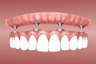 30 Best Dental Implants Near Me